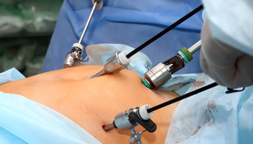 Laparoscopic Surgery